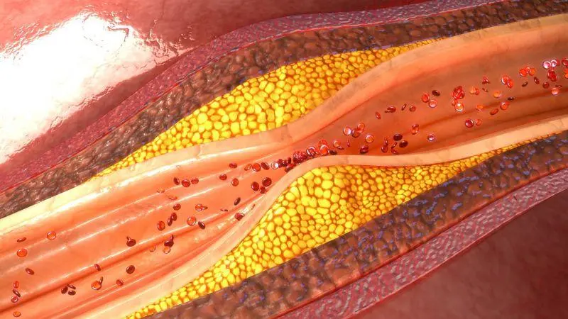 風口 | 冠脈鈣化“終結者”——血管內(nèi)沖擊波